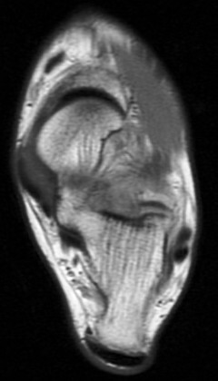 Figure 3 for case sinus tarsi  syndrome ( RID3222 )